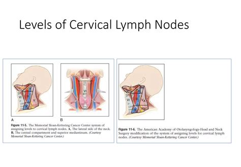 Sentinel Lymph Node Biopsy Pptx