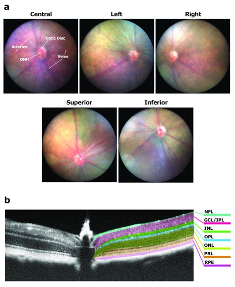 Orientation Of A Set Of Five Fundus Images And Retinal Layers Depicted