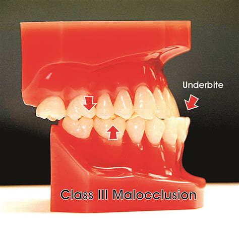 What Are The Types Of Malocclusions Ask An