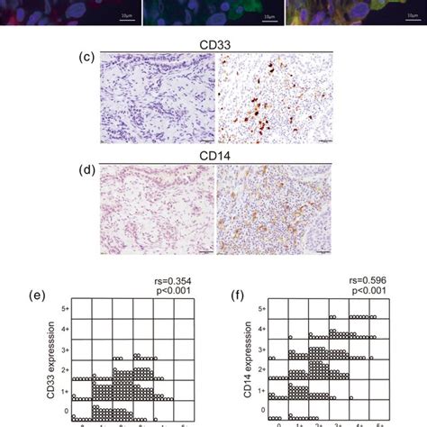 The Suppression Effect Of LILRB4 Blockade On CD33 Myeloidderived