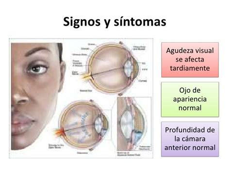 Glaucoma