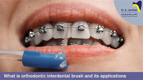 What is orthodontic interdental brush and its applications? - Dr Jamilian