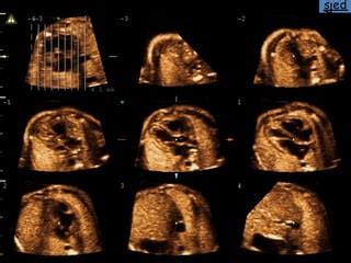 Apunte Avances En Ecocardiografia Fetal Ppt