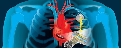 ¿qué Es Un Marcapasos Intervencionismo Cardiovascular