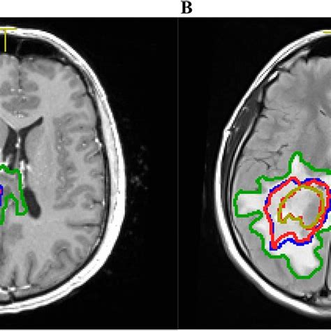 Manual Segmentation Of The Glioblastoma Compartments On T1 Weighted