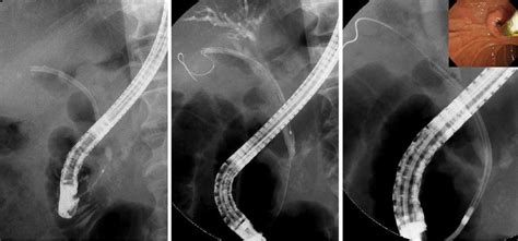 A bile duct plastic stent migrated into the bile duct. A... | Download Scientific Diagram