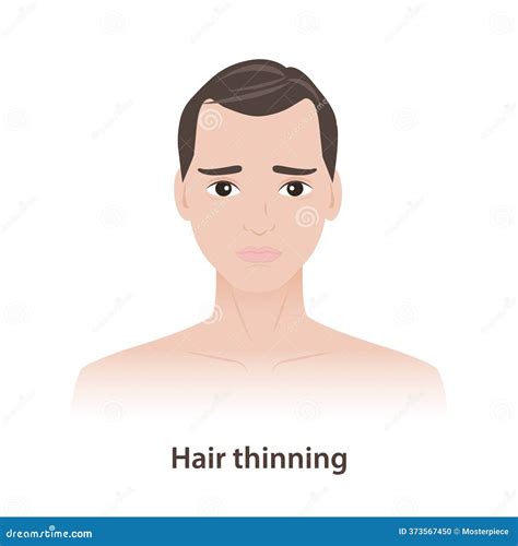 Hair Thinning Progression Stages In Adult Royalty-Free Stock Image