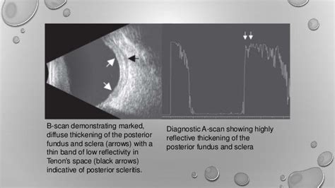 Ultrasound of eye - B scan