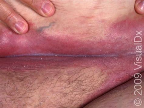 What Does Shingles Look Like Shingles Rash Pictures Blisters Under