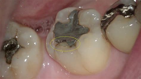 【むし歯虫歯治療・セラミック治療】右下奥歯の咬むと痛い方の治療 Inoue Dental Clinic｜立川の歯科医院