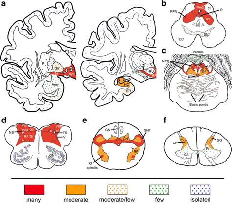 Schematic Distribution Of Tau Pathology In Anti Iglon Related