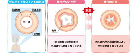 ぜんそくの治療 症状について調べる ぜんそくタウン アストラゼネカ（az）