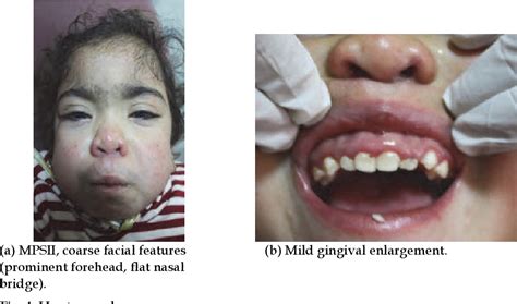 Teeth Genetic Diseases