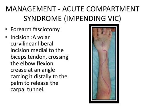 Volkmann¶s Ischemic Contracture