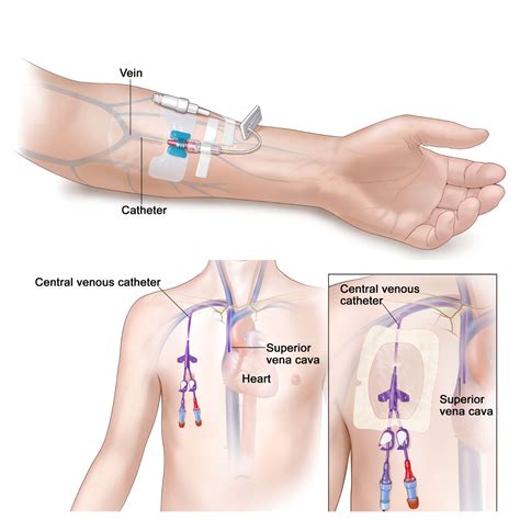 IV Line - KMED-KANGYI MEDICAL