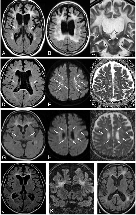 Figure 2 From Adult Onset Leukoencephalopathy With Axonal Spheroids And