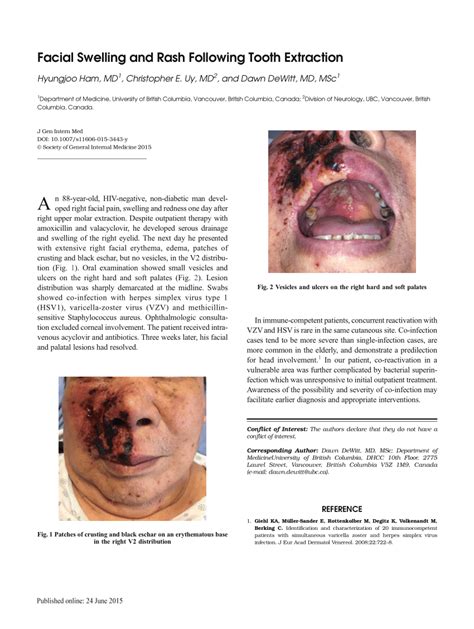 Pdf Facial Swelling And Rash Following Tooth Extraction