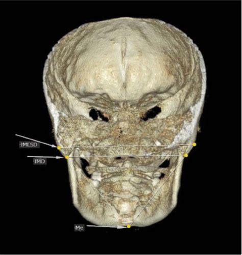 Morphometric Analysis Of The Inter Mastoid Triangle For Sex