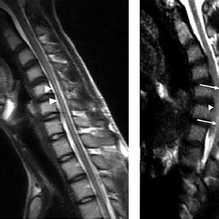 Serial cervical MRI of 17-year old male with Hirayama Disease. Neutral ...