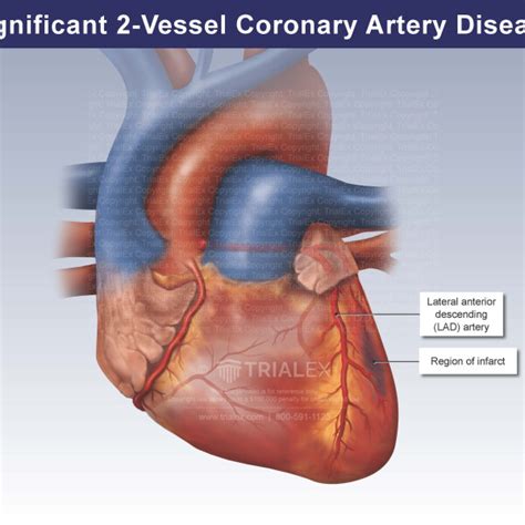 Coronary Blockages Trial Exhibits Inc