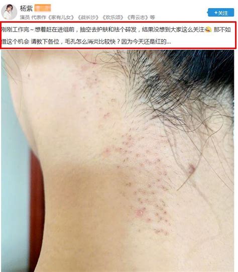 現身整形美容醫院，楊紫整容實錘了？她調皮回應：毛孔怎麼消炎？ 每日頭條