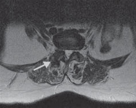 Mri Lumbar Facet Joint