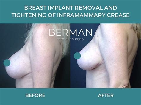 Breast Augmentation Surgery Va Berman Cosmetic Surgery