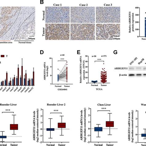 Arhgef11 Is Upregulated In Hcc Tissues A Representative Ihc Staining