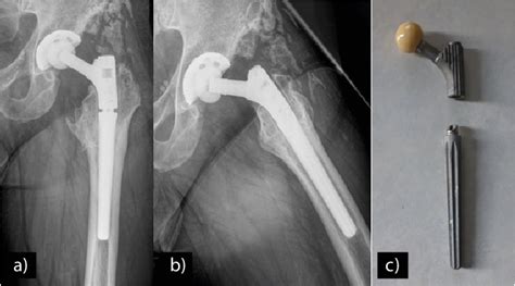 Figure From Recurrent Fracture Of The Cone Of A Morse Taper Junction