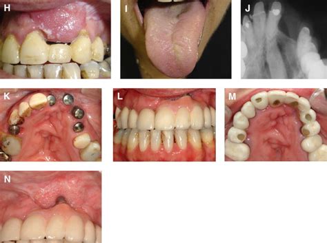 Dental Implants Placed Into Alveolar Clefts Reconstructed With Tongue