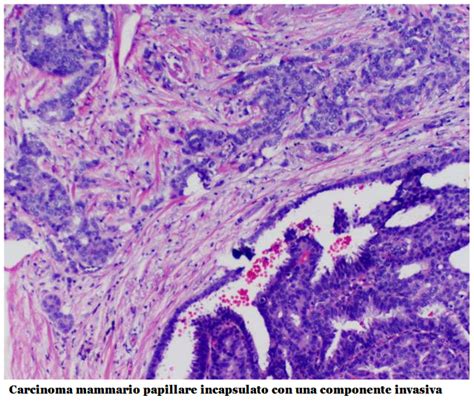 Carcinoma Mammario Papillare FertilityCenter