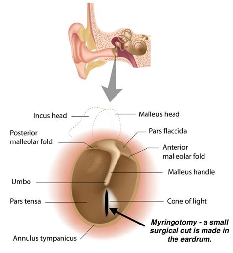 Office Tympanostomy Tube Placement Fort Worth ENT Sinus