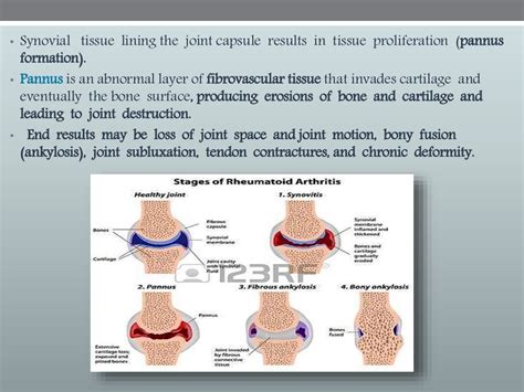 Management Of Rheumatoid Arthritis