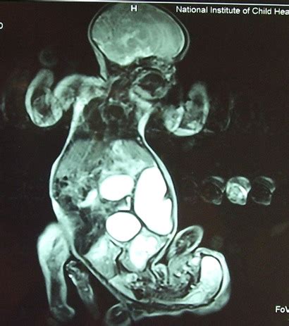 MRI of conjoined twins. | Download Scientific Diagram