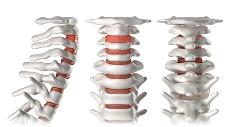 Discectomy vs. Laminectomy - Austin, TX Vertebrae and Spine Surgery