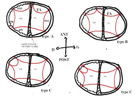 Canal Atrioventriculaire Imagerie Des Malformations Cardiaques