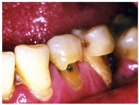 Tooth Abrasion Vs Erosion