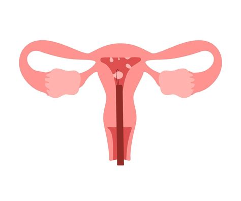 Uterus organ with polyp, removal polyp. Check health of woman organ