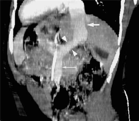 Thin Slab Maximum Intensity Projection Of An Abdominal Ct Of A