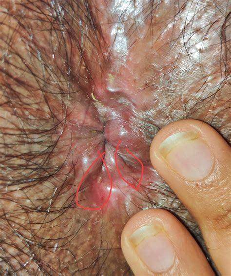 Anal Fissures Album On Imgur