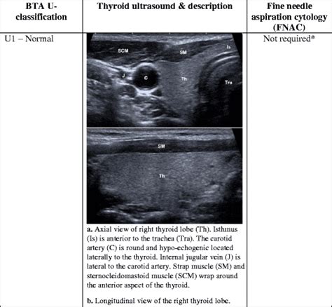 Thyroid Cyst Symptoms