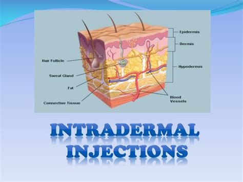 INTRADERMAL INJECTION | PPT