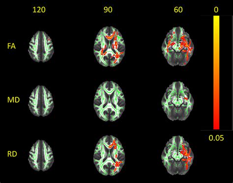 Frontiers Distinctive Patterns Of Seizure Related White Matter