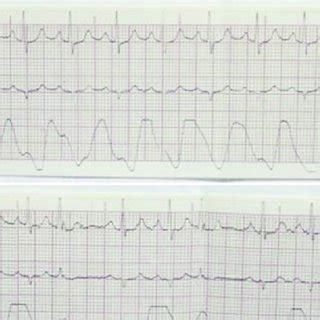 (a) ECG in Lead II showing a normal sinus rhythm prior to stimulation ...