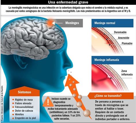 Qué es la meningitis cómo se contagia y su tratamiento MIX Diario