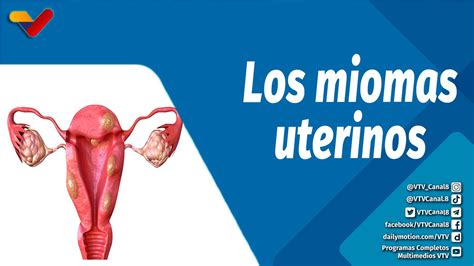 Actitud Saludable Qué Son Los Miomas Uterinos Y Cómo Tratarlos Vídeo Dailymotion