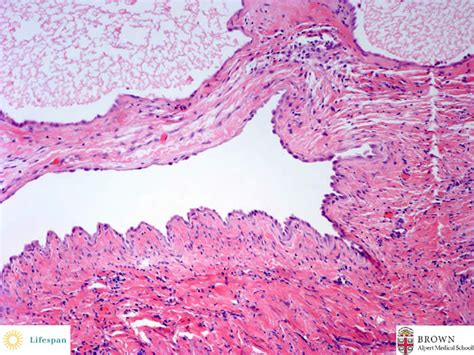 Gartners Duct Cyst Histology