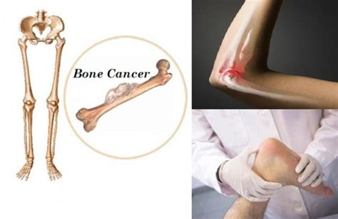 What R The Symptoms Of Bone Cancer Cancerwalls