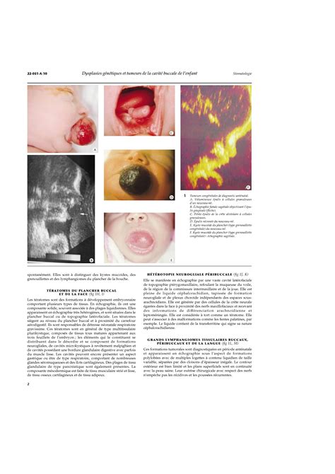 SOLUTION Dysplasies G N Tiques Et Tumeurs De La Cavit Buccale De L