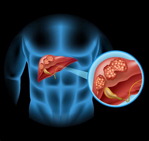 Cancer Du Foie Quels Sont Les Symptômes Et Peut On Le Soigner